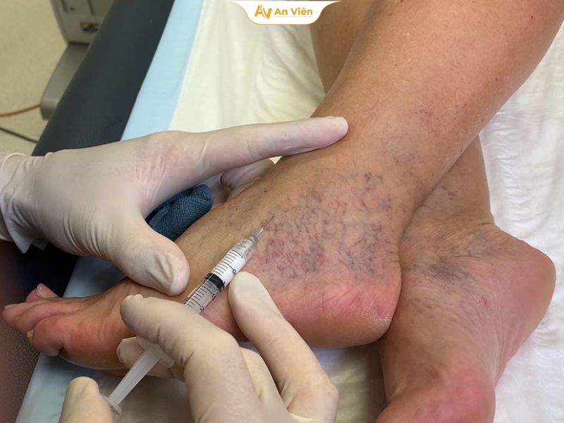 Tiêm xơ bị bầm tím có sao không