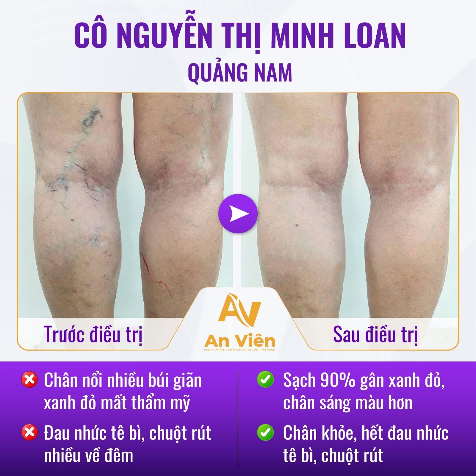 Tiêm xơ bị bầm tím có sao không