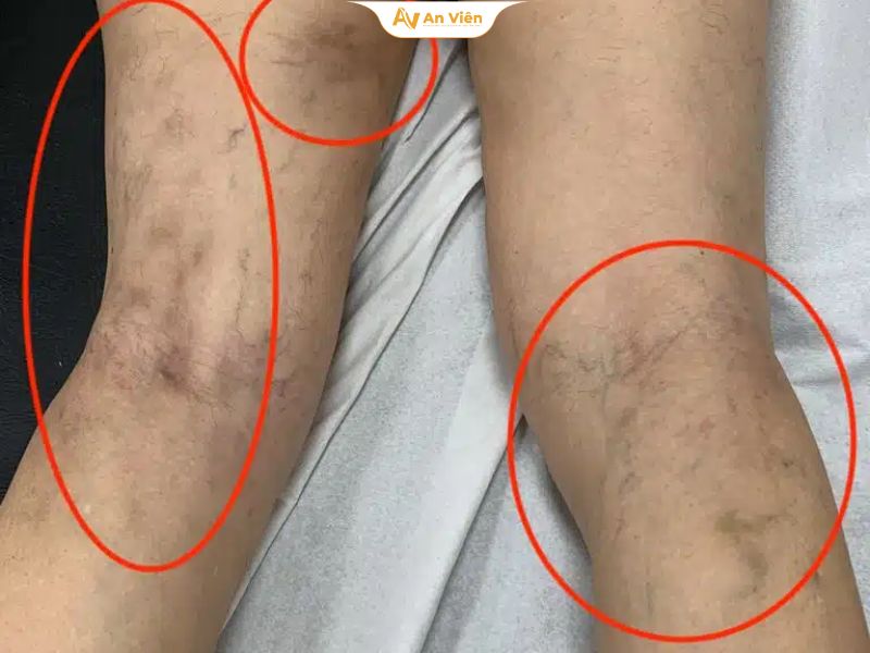 Tiêm xơ bị bầm tím có sao không