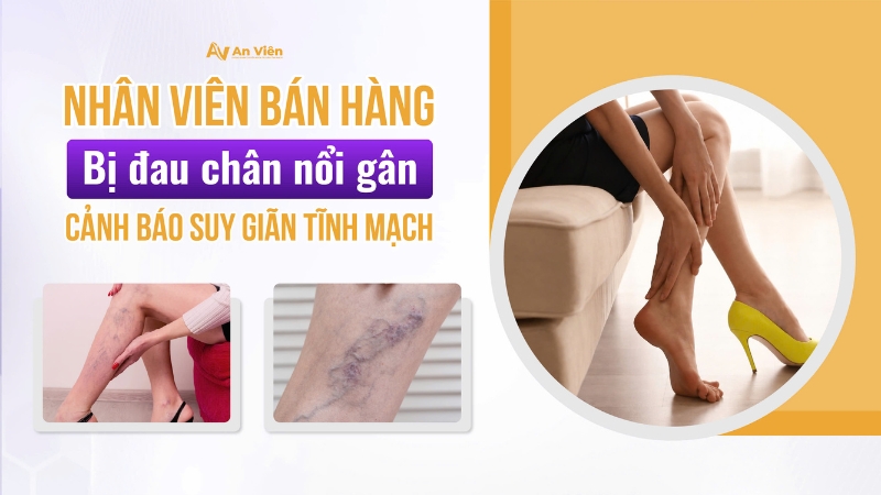 Nhân viên bán hàng bị đau chân nổi gân: Cảnh báo suy giãn tĩnh mạch 12 gian tinh mach 1 3