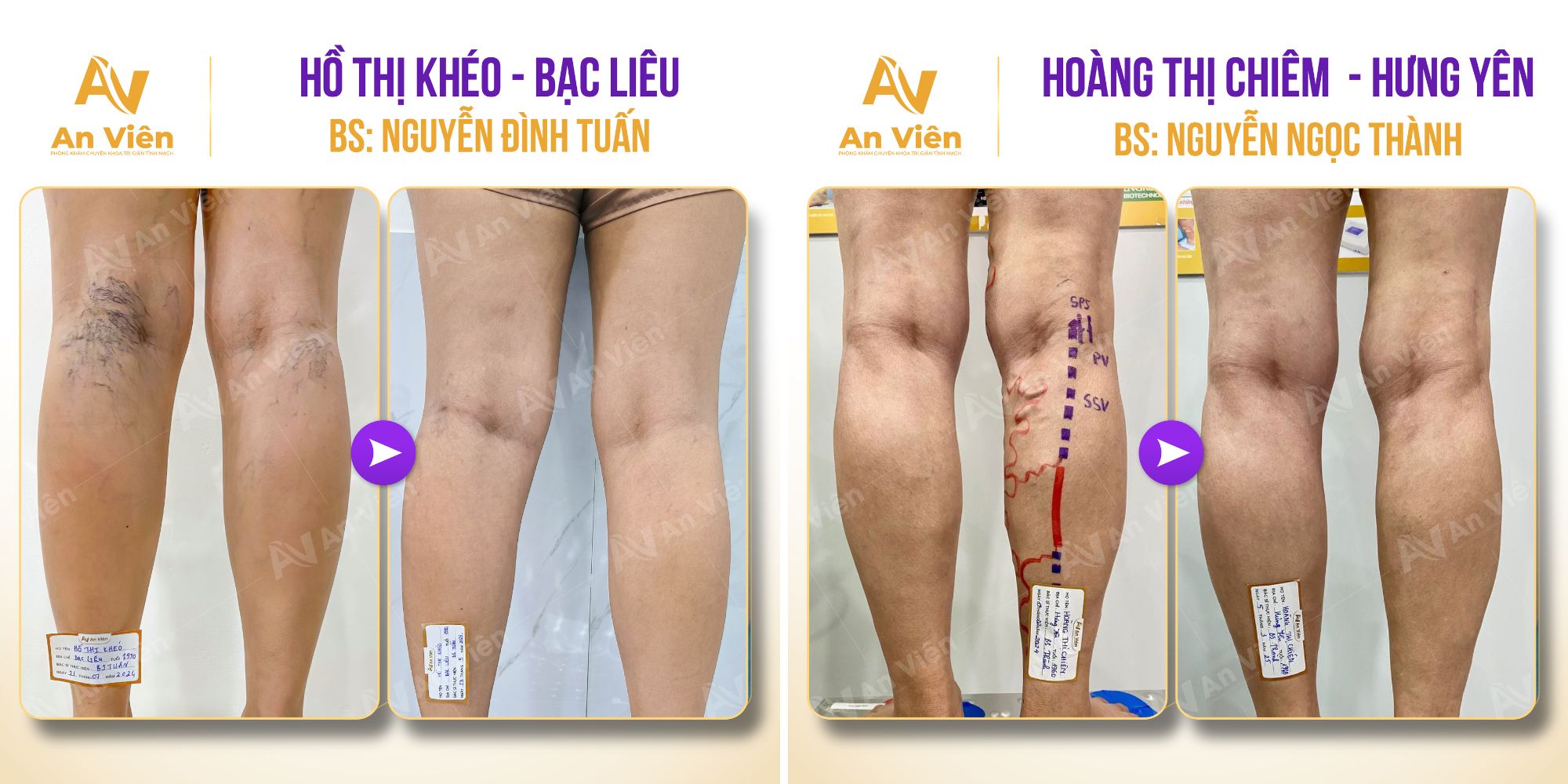 An Viên đã nói "không" với điều gì để chỉ đi sâu vào tĩnh mạch? 8 An Viên
