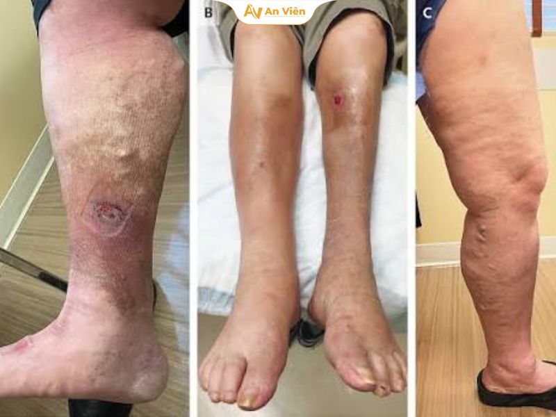 Giác hơi trị suy giãn tĩnh mạch: Bác sĩ nói gì về phương pháp này? 7 Giác hơi trị suy giãn tĩnh mạch