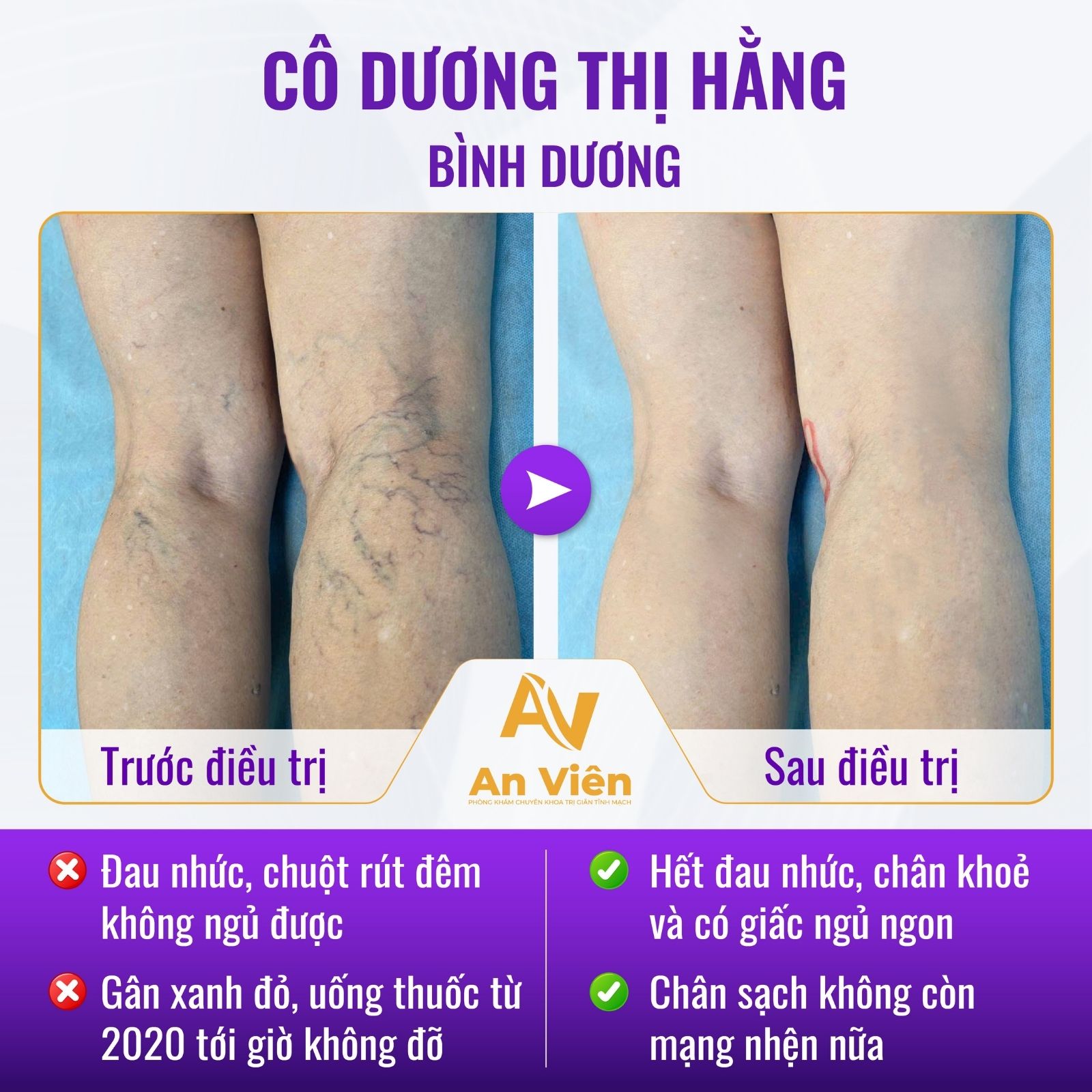 Giác hơi trị suy giãn tĩnh mạch: Bác sĩ nói gì về phương pháp này? 10 Giác hơi trị suy giãn tĩnh mạch