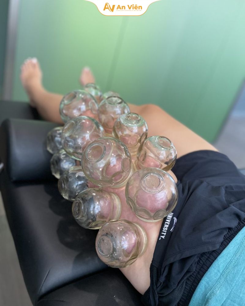 Giác hơi trị suy giãn tĩnh mạch: Bác sĩ nói gì về phương pháp này? 6 Giác hơi trị suy giãn tĩnh mạch