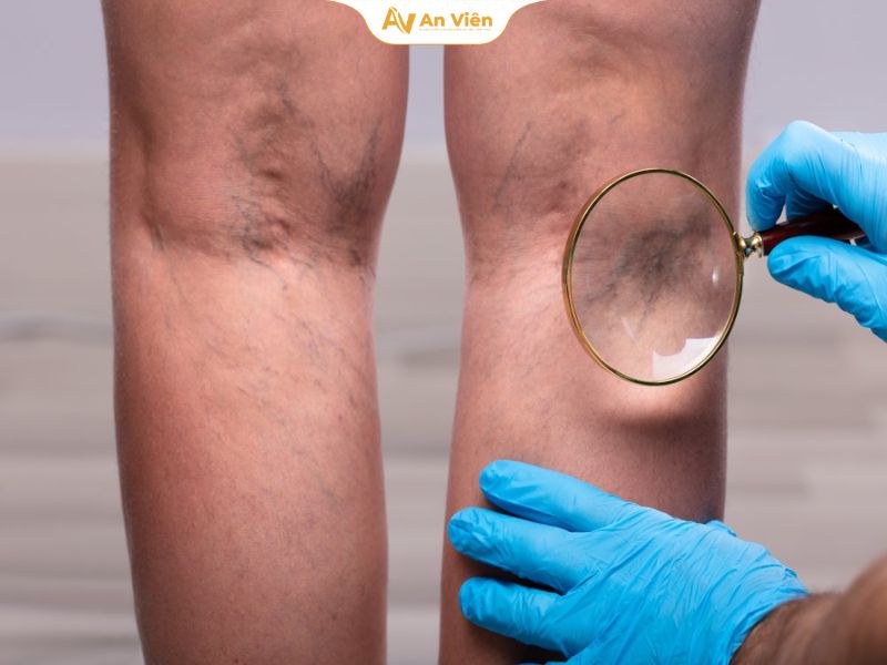 Hội chứng chân không yên có nguy hiểm không? Dấu hiệu cần biết 8 Hội chứng chân không yên