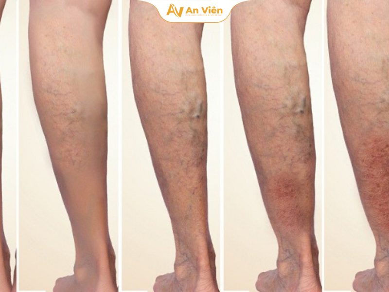 Giãn tĩnh mạch chân đi nghĩa vụ quân sự được không? Bác sĩ chuyên khoa tĩnh mạch giải đáp 10 Các mức độ giãn tĩnh mạch chân ảnh hưởng thế nào đến kết quả khám sức khỏe NVQS