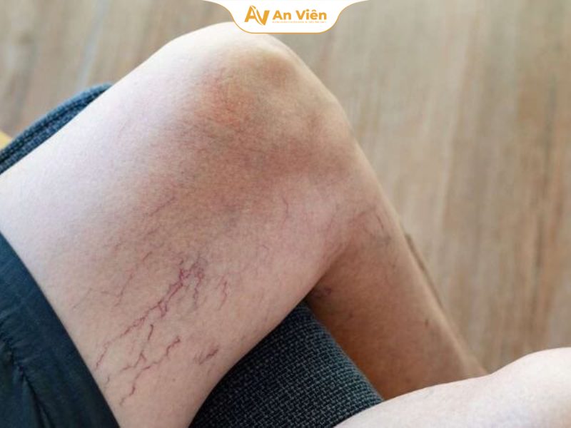 Giãn tĩnh mạch tái phát sau điều trị: Vì sao bệnh quay lại và khi nào cần can thiệp? 7 5 nguyên nhân khiến giãn tĩnh mạch tái phát sau điều trị ở chân