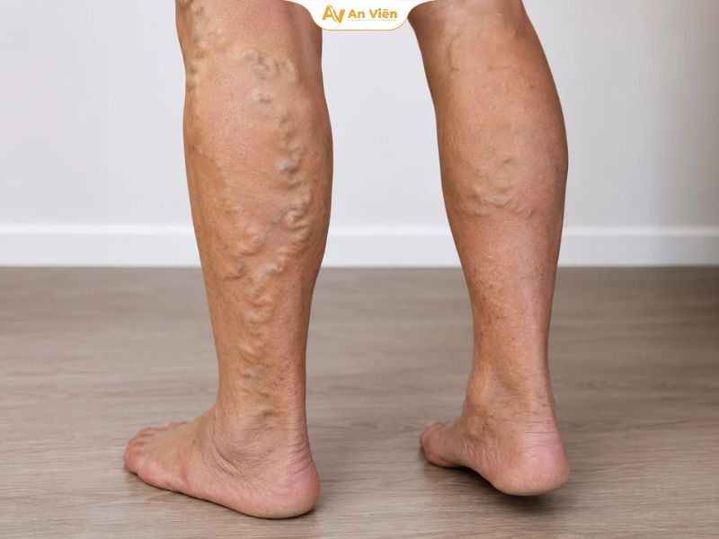 Suy giãn tĩnh mạch cấp độ 3: Chân phù có nguy hiểm không, điều trị thế nào? 13 Chân phù nhiều hơn vào cuối ngày