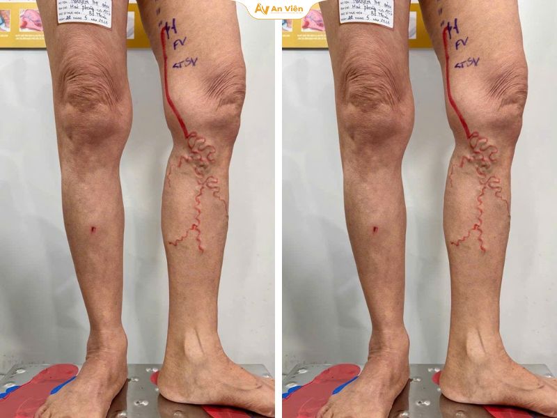 Sau thời gian điều trị tại viện công, người bệnh quyết định tìm hướng tiếp cận khác tại An Viên 3 An Viên