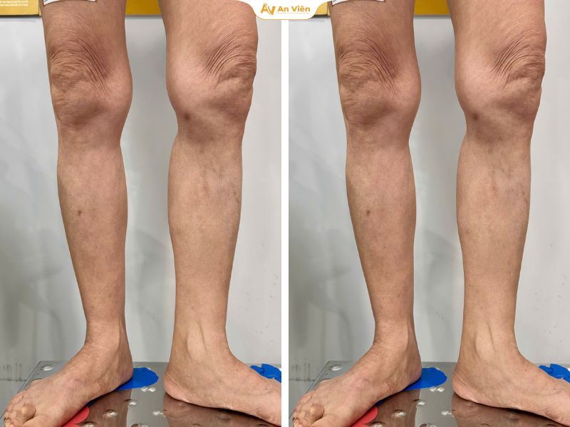 Sau thời gian điều trị tại viện công, người bệnh quyết định tìm hướng tiếp cận khác tại An Viên 4 An Viên