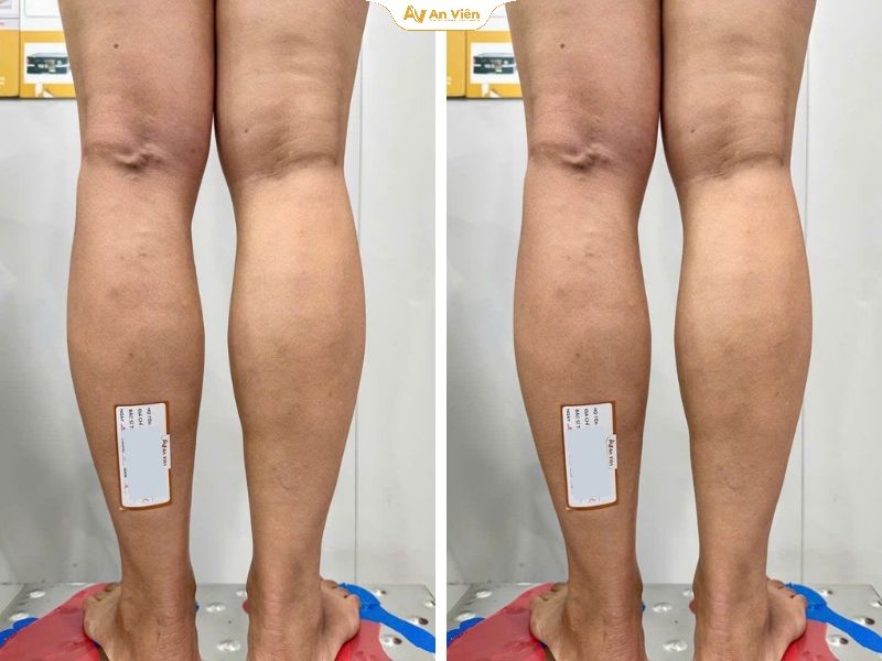 Điều trị bằng Laser EVLA