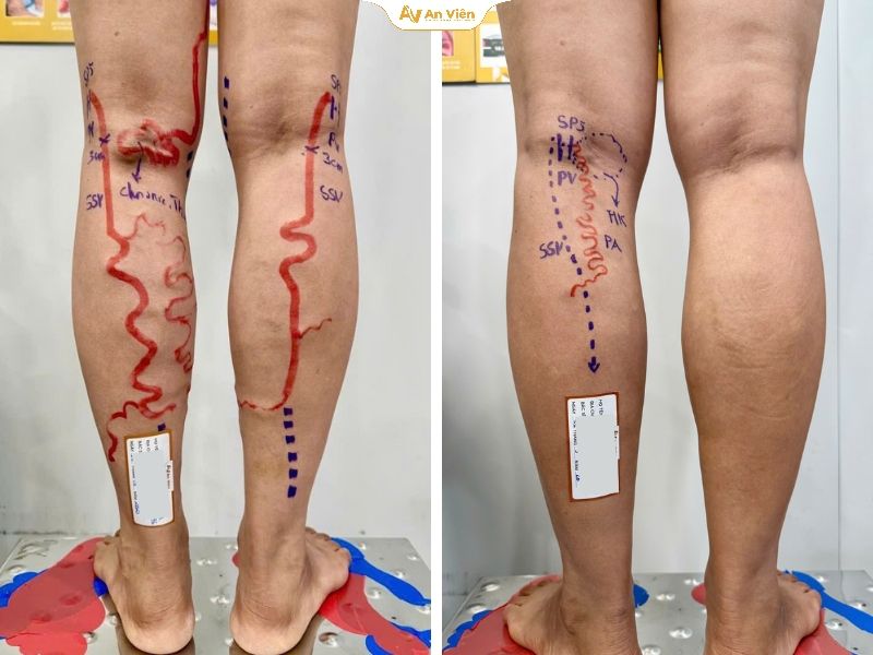 Điều trị bằng Laser EVLA