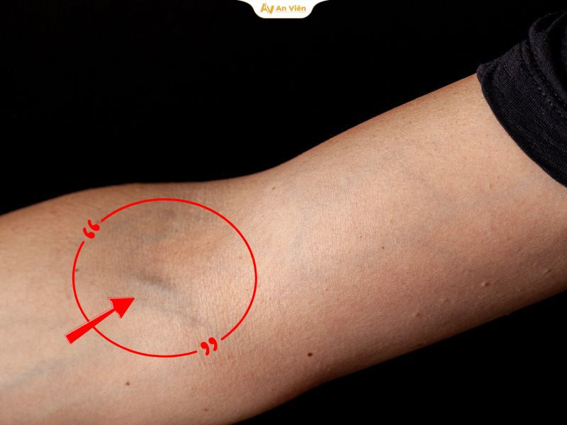 6 dấu hiệu giãn tĩnh mạch khuỷu tay không nên chủ quan 6 Giãn tĩnh mạch khuỷu tay