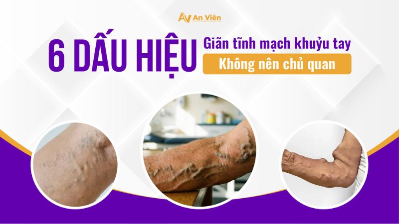 6 dấu hiệu giãn tĩnh mạch khuỷu tay không nên chủ quan 15 Giãn tĩnh mạch khuỷu tay