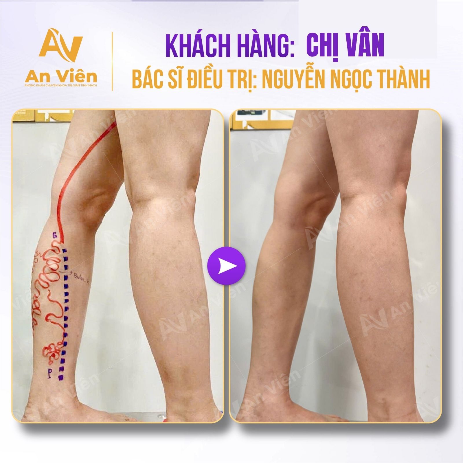 Hành trình điều trị suy giãn tĩnh mạch của chị Vân: Quyết định thay đổi nhỏ, kết quả ngoài mong đợi 8 Hành trình điều trị suy giãn tĩnh mạch