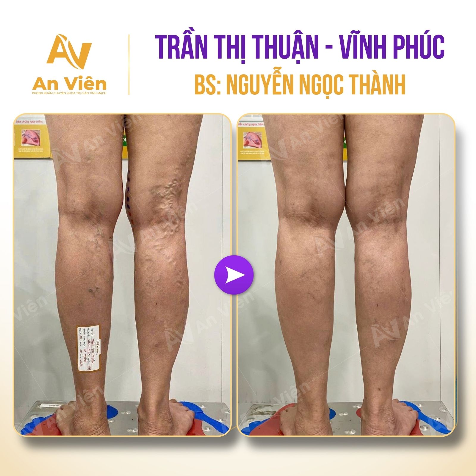 Lười vận động gây suy giãn tĩnh mạch