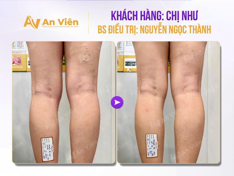 Sau sinh 1 năm mới phát hiện giãn tĩnh mạch, chị Như được bác sĩ An Viên tư vấn gì? 6 Phát hiện giãn tĩnh mạch