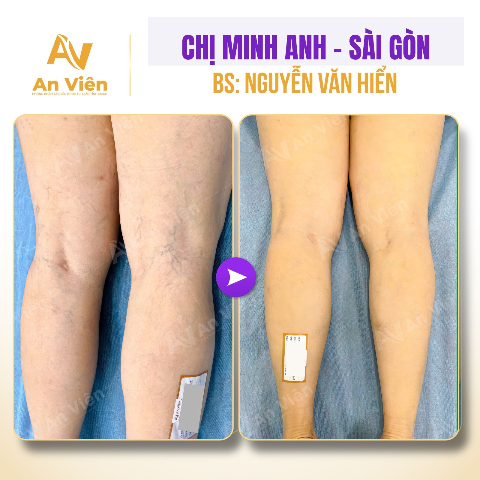 Bắt bệnh mẹ bỉm: Tại sao càng về chiều, vùng cổ chân lại càng sưng phù nổi rõ gân tím? 8 Sưng phù nổi rõ gân tím