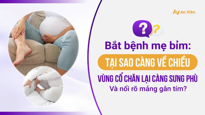 Sưng phù nổi rõ gân tím