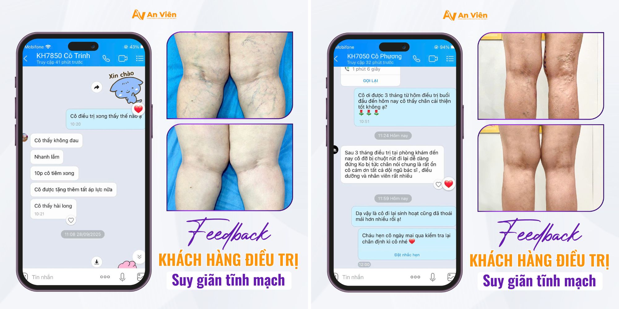 Bác sĩ đính chính: Suy giãn tĩnh mạch có thực sự tự khỏi nếu chỉ nghỉ ngơi? 10 Suy giãn tĩnh mạch