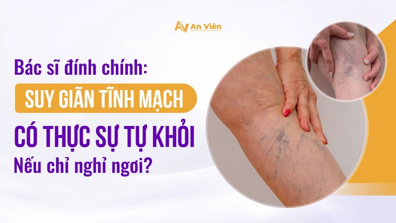 Bác sĩ đính chính: Suy giãn tĩnh mạch có thực sự tự khỏi nếu chỉ nghỉ ngơi? 22 Suy giãn tĩnh mạch