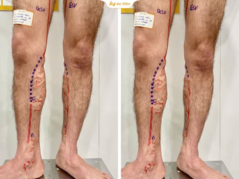 Bôi 5 tuýp kem mà gân vẫn nổi ngoằn ngoèo – Bài học đắt giá từ người bệnh 4 Suy giãn tĩnh mạch