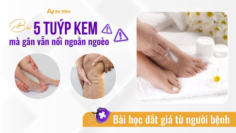 Suy giãn tĩnh mạch