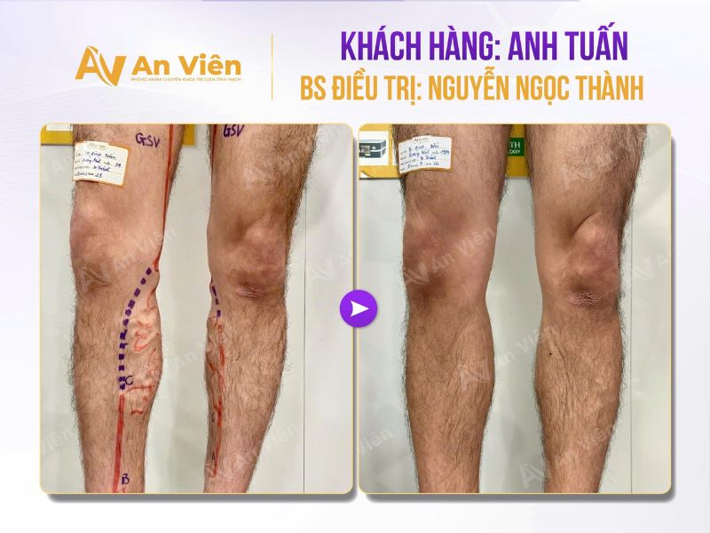 Bôi 5 tuýp kem mà gân vẫn nổi ngoằn ngoèo – Bài học đắt giá từ người bệnh 6 Suy giãn tĩnh mạch