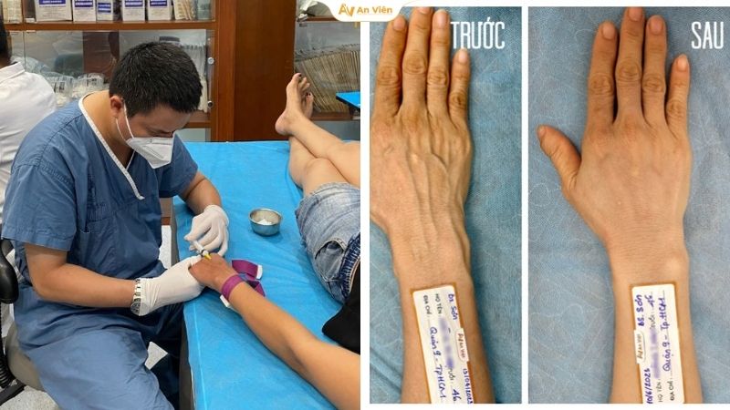 Tĩnh mạch tay nổi do giảm cân