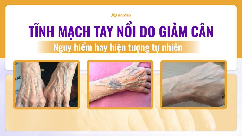 Tĩnh mạch tay nổi do giảm cân
