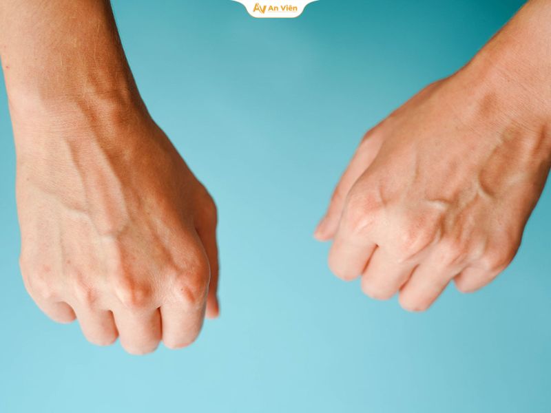 Tĩnh mạch tay nổi do giảm cân