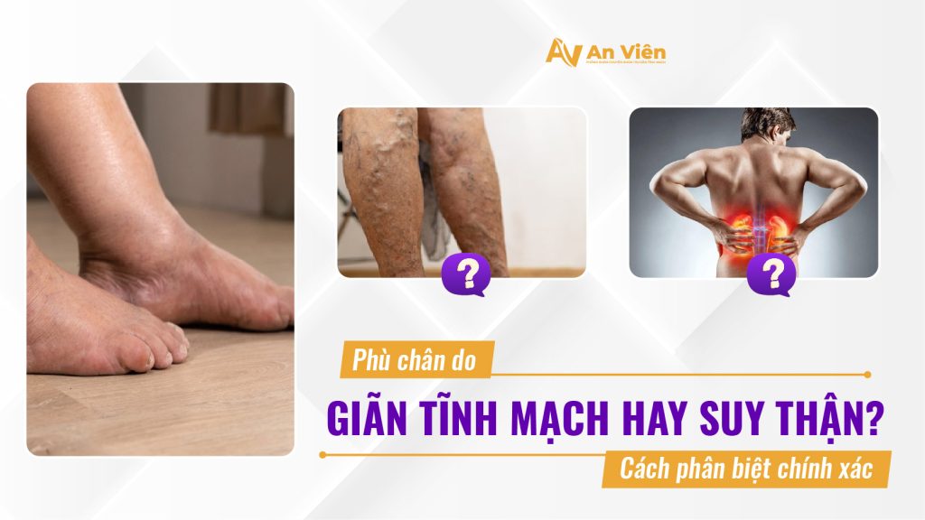 Phù chân do giãn tĩnh mạch hay suy thận? Cách phân biệt chính xác 16 an vien 1