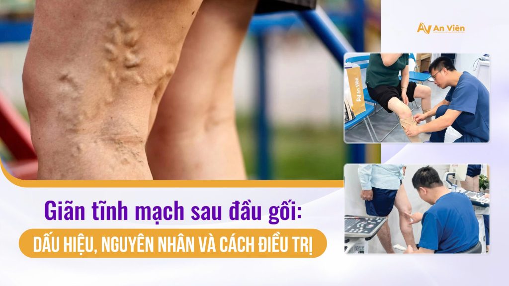 Giãn tĩnh mạch sau đầu gối: Dấu hiệu, nguyên nhân và cách điều trị 14 an vien 1 3