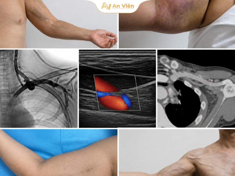 Tĩnh mạch cánh tay đầu là gì? Các bệnh lý phổ biến thường gặp 7 an-vien