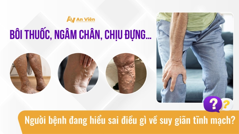 Bôi thuốc, ngâm chân, chịu đựng… Người bệnh đang hiểu sai điều gì về suy giãn tĩnh mạch? 19 hieu-lam-suy-tinh-mach