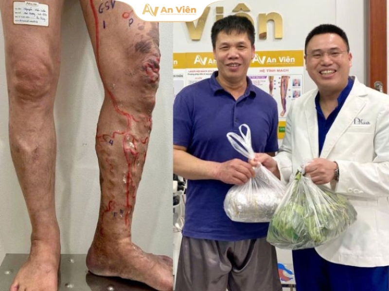 Tìm lại đôi chân nhẹ bước: Lắng nghe chia sẻ thực tế từ bệnh nhân An Viên 7 nguoi benh suy gian tinh mach 1 1